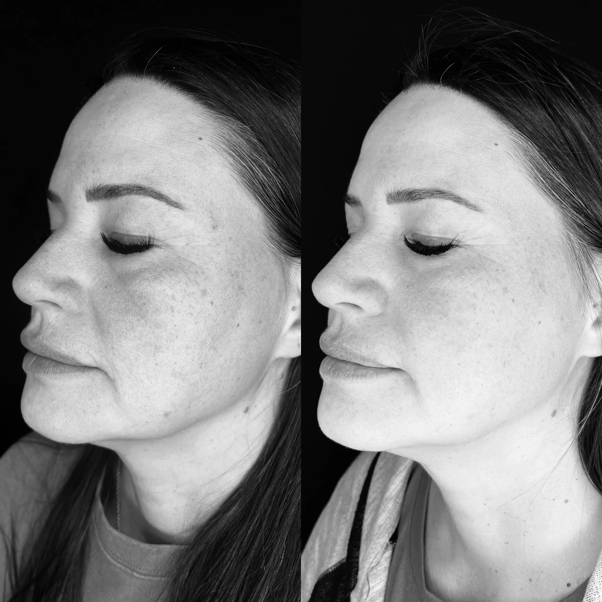 Elluminate Laser Facial in Draper, Utah | Femme Moderne Center for Aesthetics