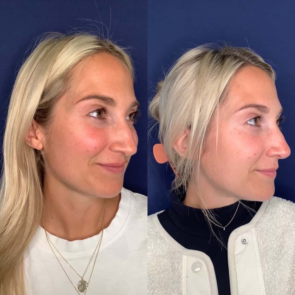 Before and After Microneedling Treatment Image | Femme Moderne Center for Aesthetics in Draper, UT