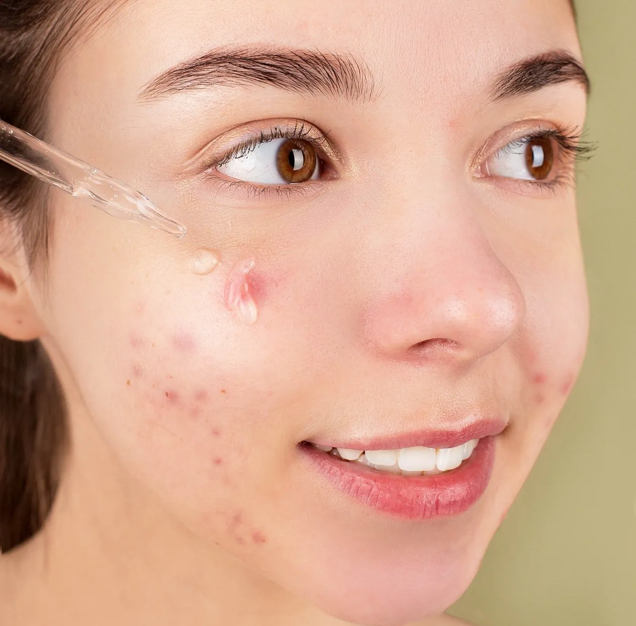 Young Girl Treating Acne Scars | Femme Moderne Center for Aesthetics in Draper, UT