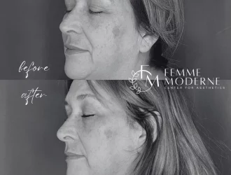 Elluminate Laser Facial | Aesthetics