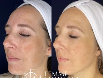 Elluminate Laser Facial | Femme