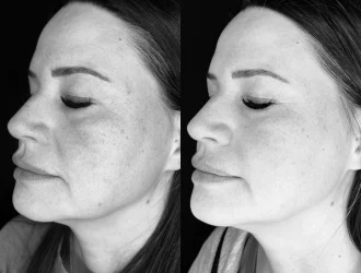 Elluminate Laser Facial in Draper, Utah | Femme Moderne Center for Aesthetics