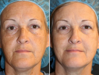 Before and After Elluminate Laser Facial Treatment Image | Femme Moderne Center for Aesthetics in Draper, UT