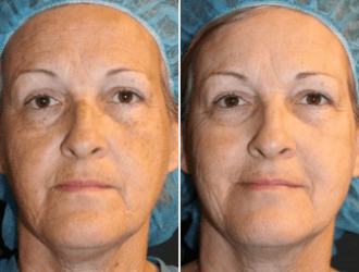 Before and After Elluminate Laser Facial Treatment Image | Femme Moderne Center for Aesthetics in Draper, UT