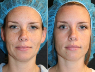 Before and After Elluminate Laser Facial Treatment Image | Femme Moderne Center for Aesthetics in Draper, UT