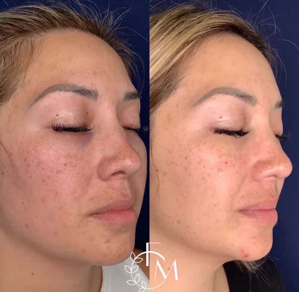 Before and After Microneedling Treatment Image | Femme Moderne Center for Aesthetics in Draper, UT