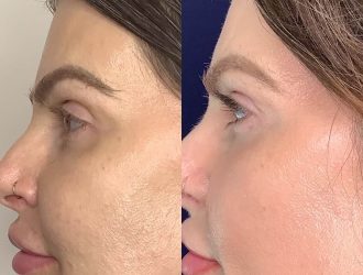 Before and After Elluminate Laser Facial treatment | Femme Moderne Center for Aesthetics in Draper, Utah