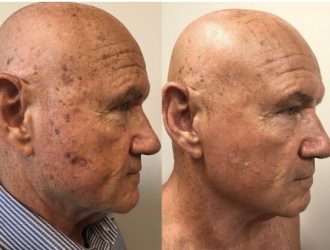 Before and After Elluminate Laser Facial treatment | Femme Moderne Center for Aesthetics in Draper, Utah
