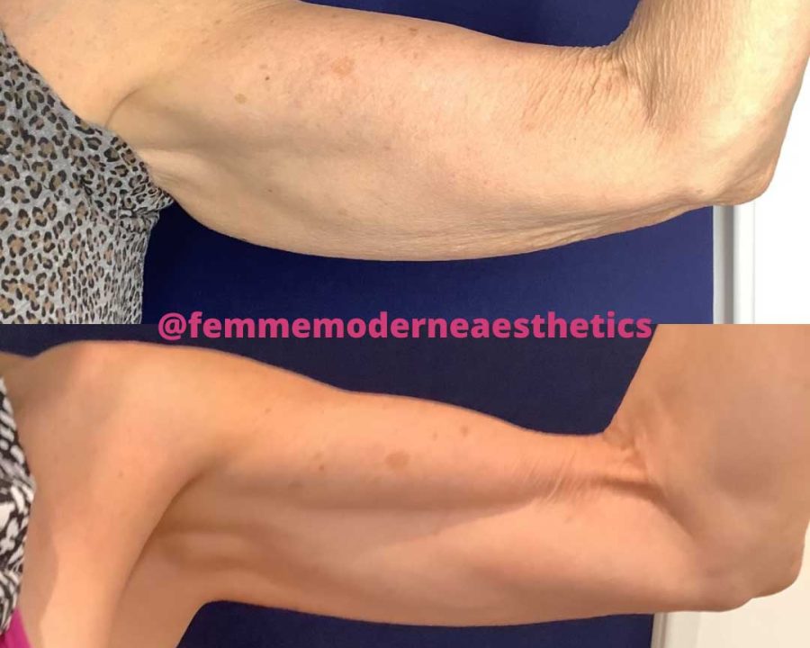 Before and After Physiq Body Contouring & Sculpting Treatment Image | Femme Moderne Center for Aesthetics in Draper, UT