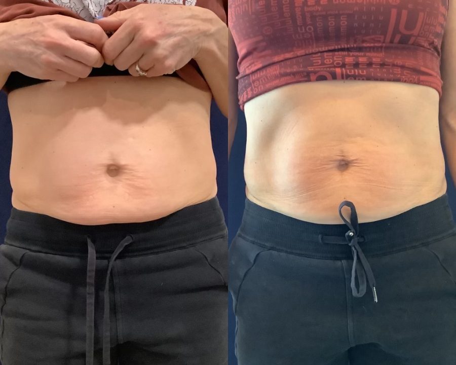 Before and After Physiq Body Contouring and Sculpting treatment | Femme Moderne Center for Aesthetics in Draper, Utah