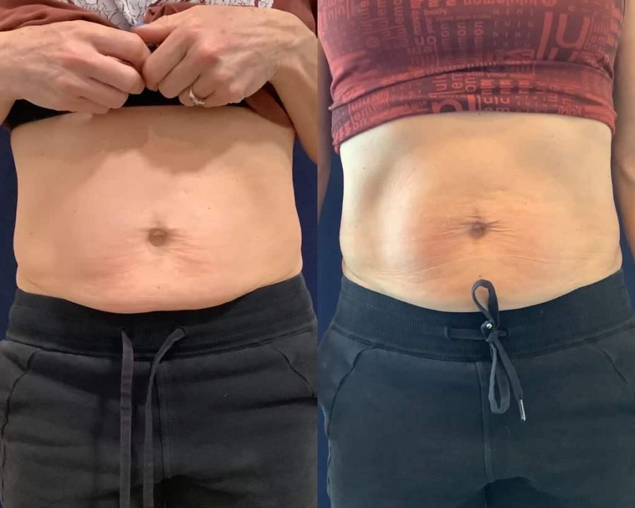 Before and After Physiq Body Contouring and Sculpting treatment | Femme Moderne Center for Aesthetics in Draper, Utah