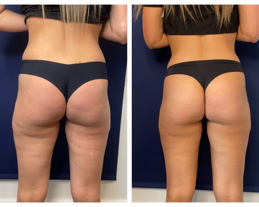 Before and After Physiq Body Contouring & Sculpting treatment | Femme Moderne Center for Aesthetics in Draper, Utah