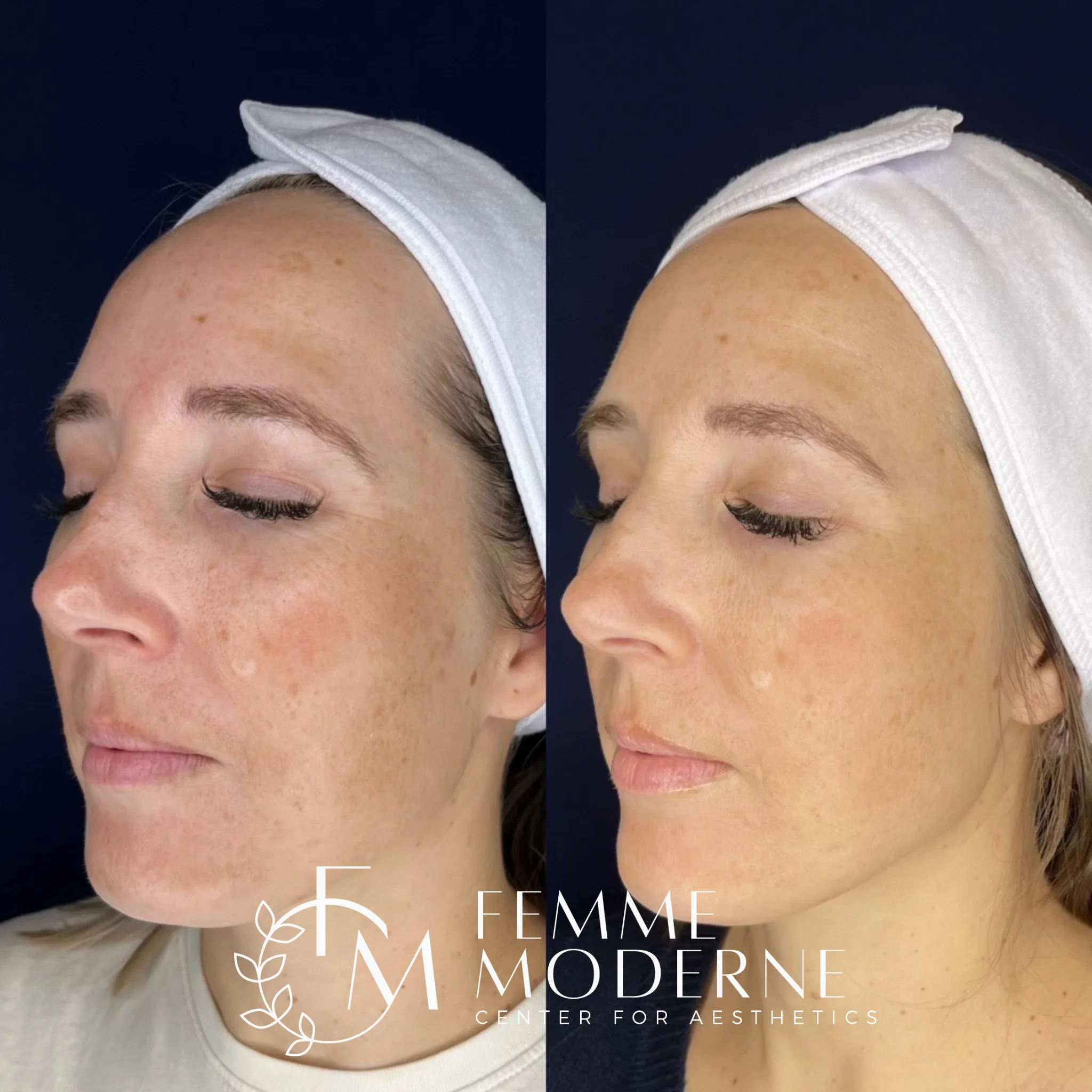 Elluminate Laser Facial | Femme