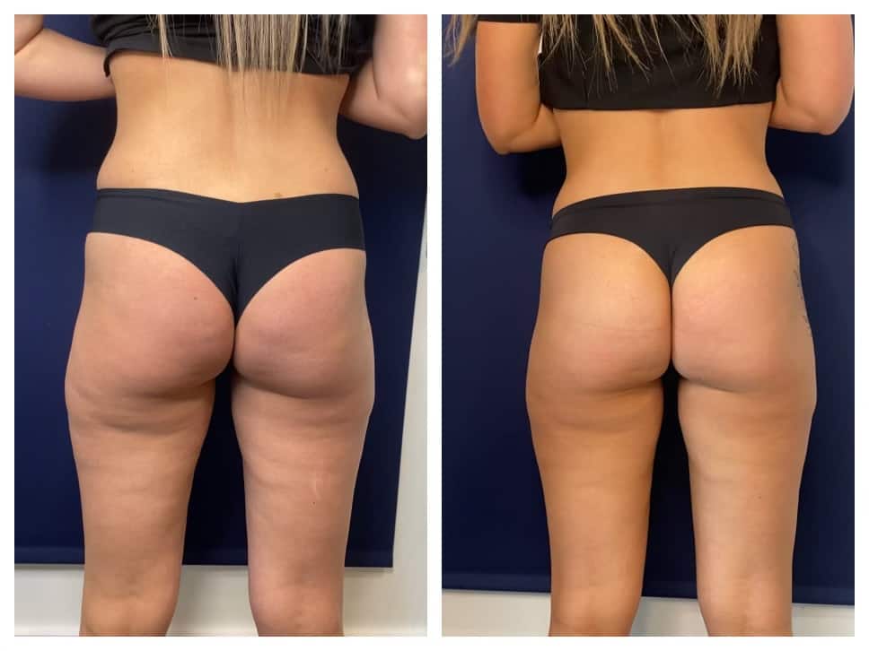 Before and After Physiq Body Contouring & Sculpting Treatment Image | Femme Moderne Center for Aesthetics in Draper, UT