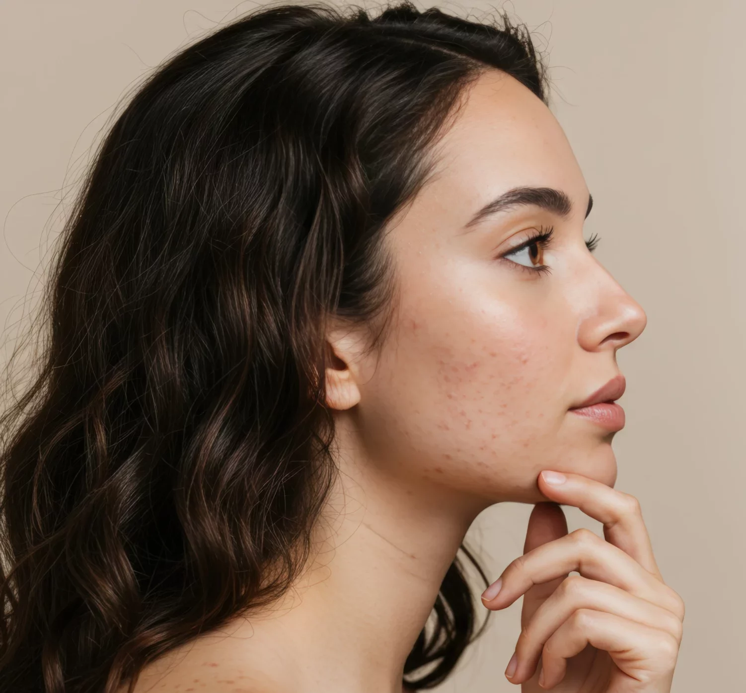 Acne Scar Removal in Draper, UT