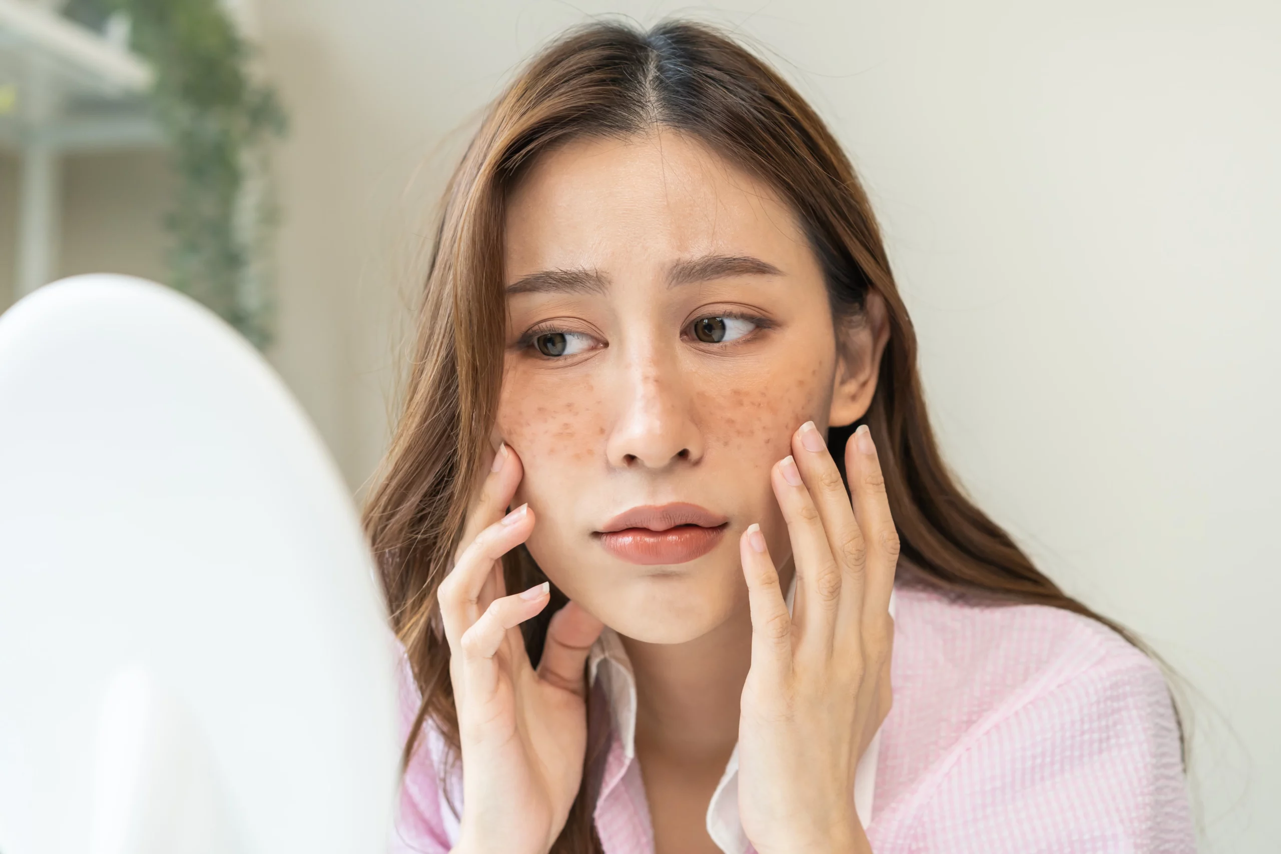 A woman Melasma Treatment in Draper, UT