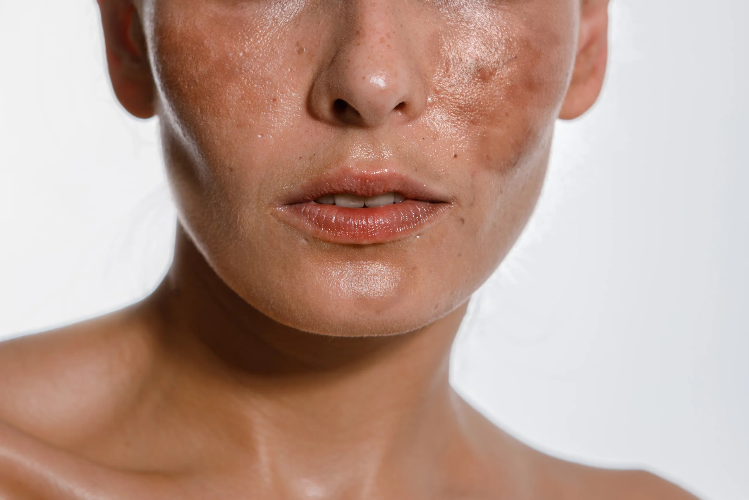 A girl with Skin Pigmentation Treatment in Draper, UT