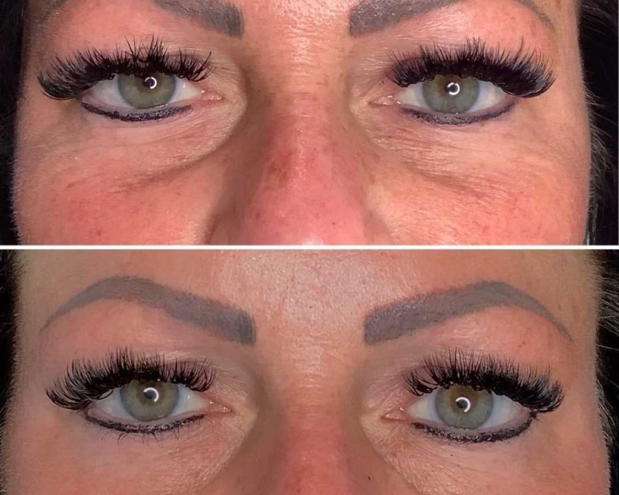 Before and After Sculptra Treatment Image | Femme Moderne Center for Aesthetics in Draper, UT